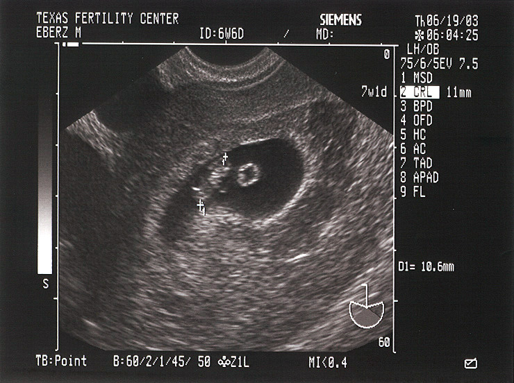 Mojo's Fetus 1